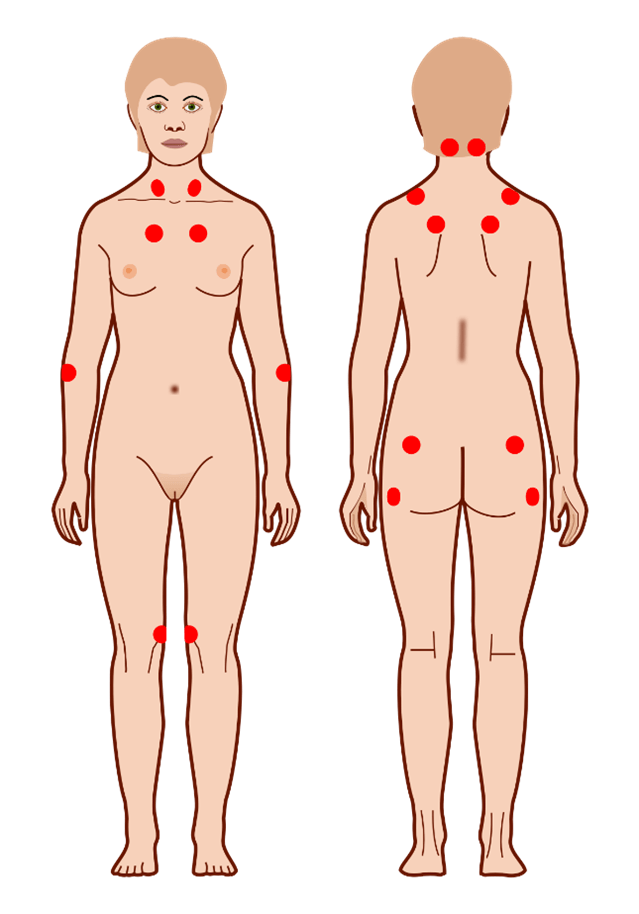18 punti della fibromialgia punti fibromialgia